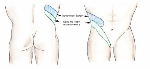 Как отличить почечную колику от другой боли в спине