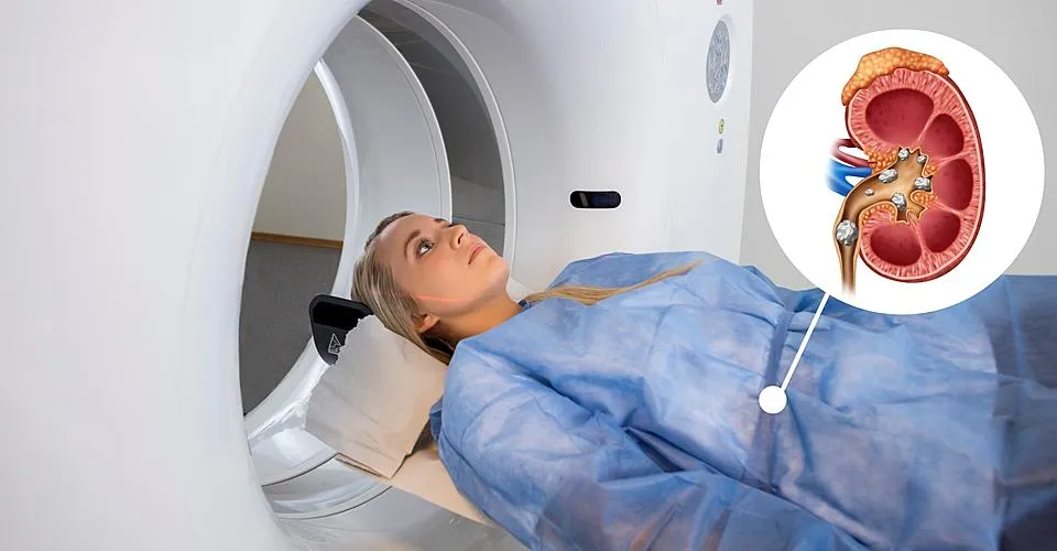 Диагностика камней почек: КТ, УЗИ, анализы