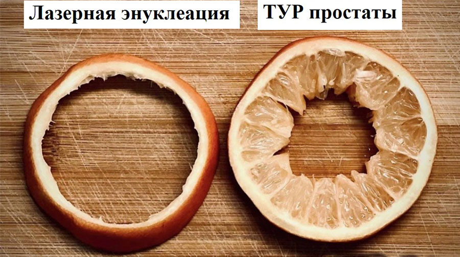 Сравнение методов ТУРП и энуклеация