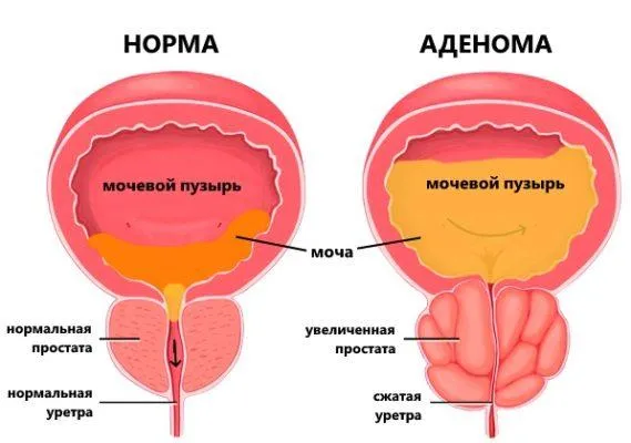 Что такое аденома простаты? Причины и симптомы