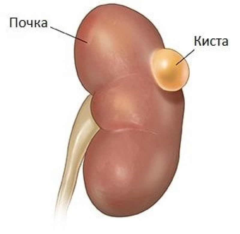 Что такое киста почки? Причины и симптомы