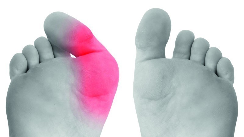 Оперативное лечение Hallux Valgus