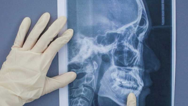 Металлоостеосинтез при переломах челюсти