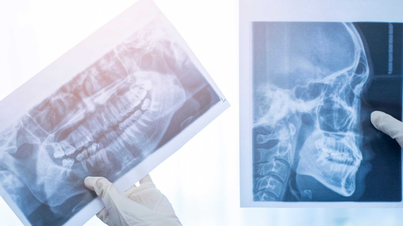 Удаление кисты челюсти