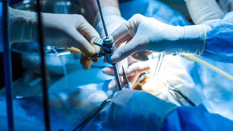 Удаление камней из протоков слюнных желез